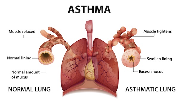 asthma